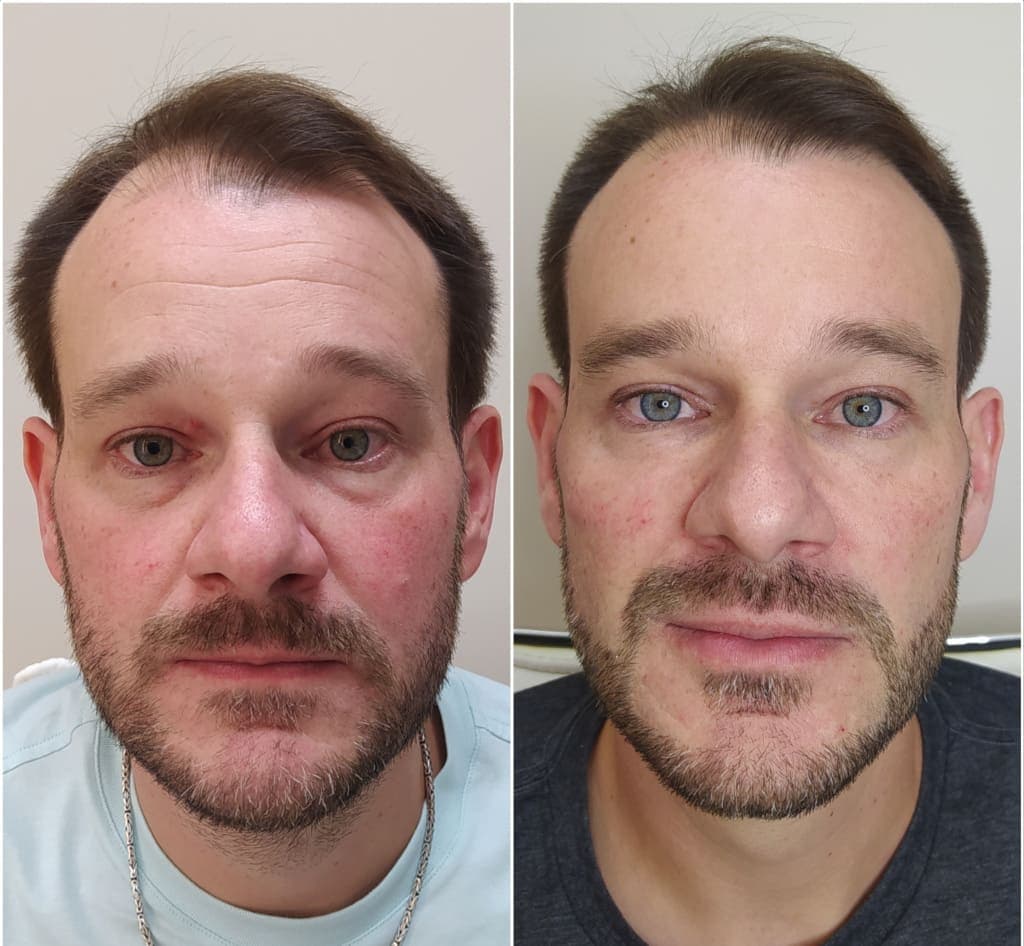 Antes e depois de bioestimuladores de colágeno