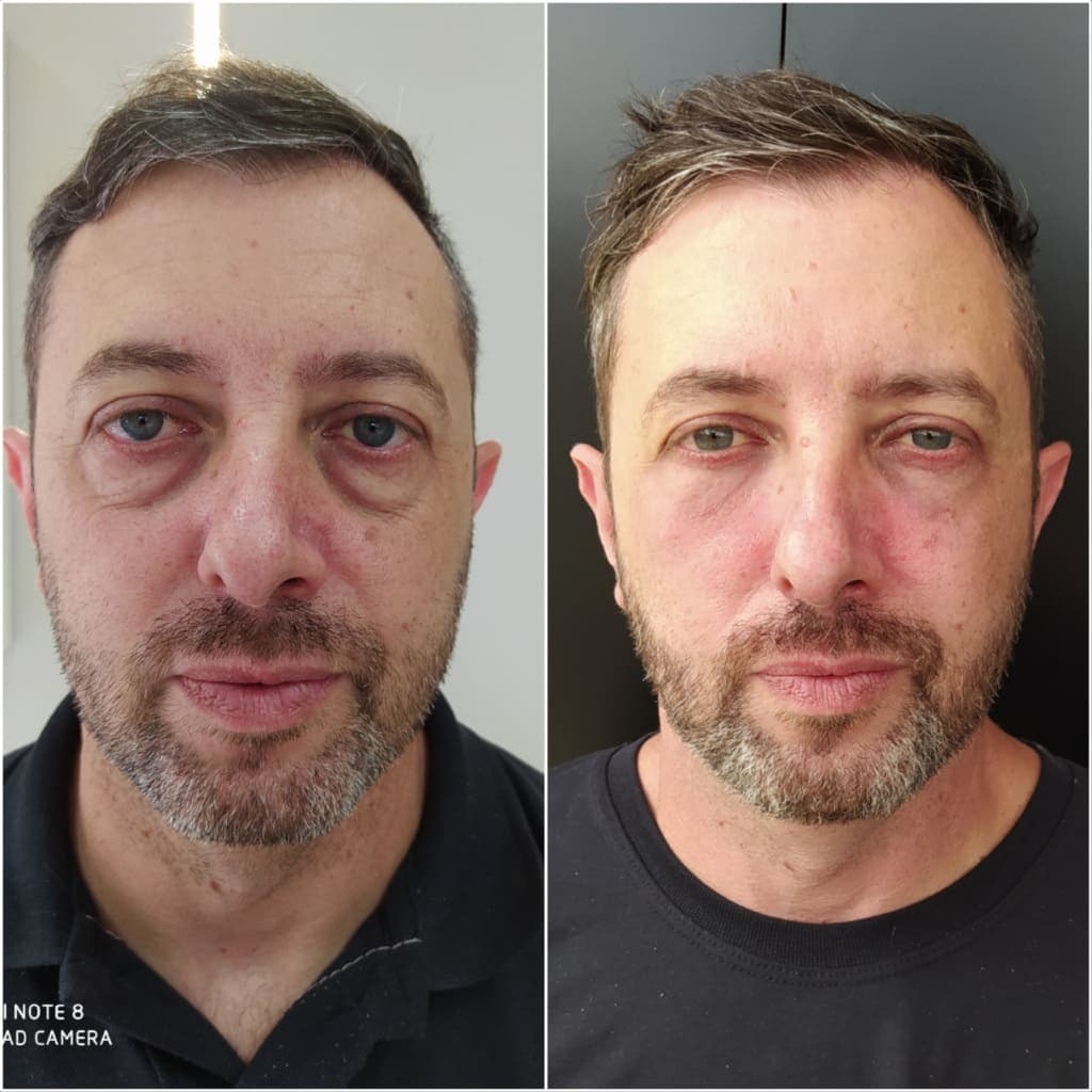Antes e depois de preenchimento com ácido hialurônico