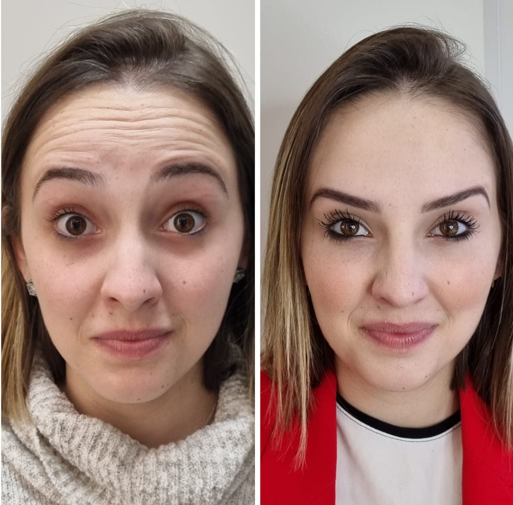 Antes e depois de toxina botulínica
